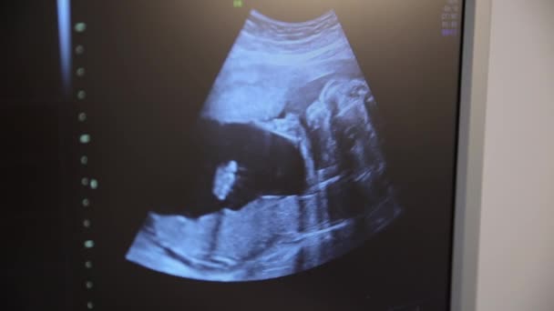 孕妇腹部的人体超声波显示在带有蓝色电子显示屏的监视器上 该图像以矩形格式显示 并以正装形式显示事件的细节 — 图库视频影像