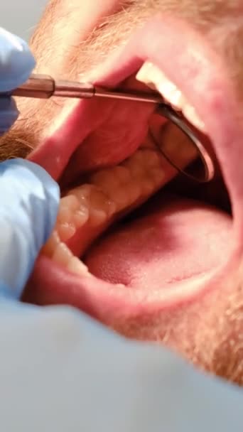Observe Dental Checkup Video Dentist Examines Mans Mouth Any Issues — Stock Video