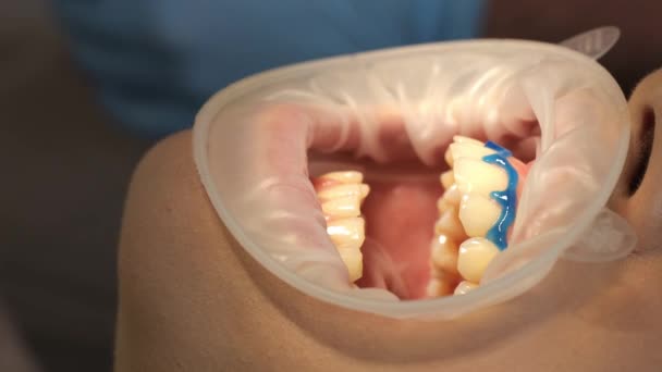Kontroluji Zuby Detailní Záběr Otevřených Úst Během Návštěvy Zubaře Chránič — Stock video