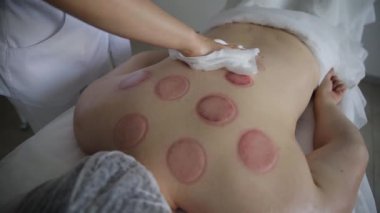 Emme kabı tedavisi gören bir kadının sırtındaki yaralar. Yüksek kalite 4k görüntü