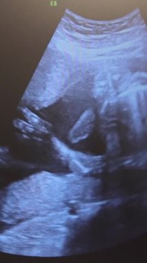 Monitördeki hamile bir kadının teşhisi altında ceninin ultrasonunun dikey videosu. Hamilelik testi. Ultrason sırasında cenin hareketleri