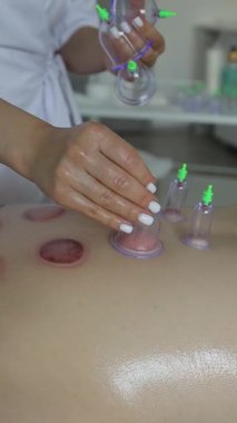 Vakum kabı kullanarak vakum terapisi yapan bir doktorun yakın çekimi. Dikey video.