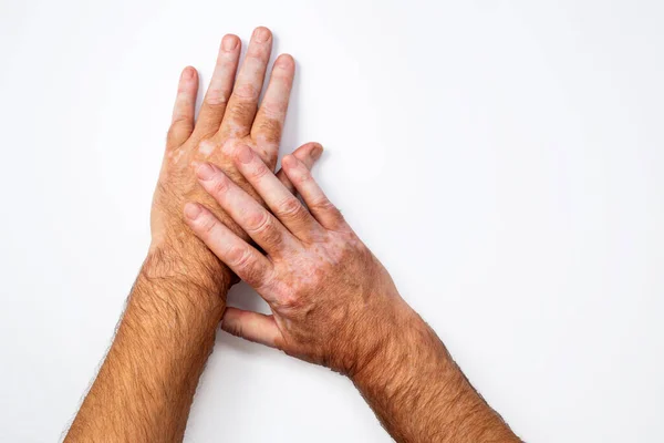 Beyaz arka planda vitiligo derisi pigmentasyonu olan eller. - Evet. Yüksek kalite fotoğraf