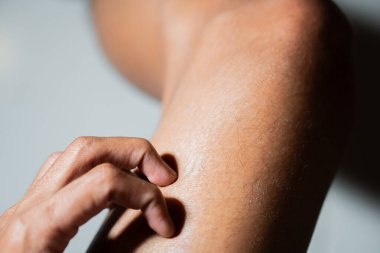 Bir insanın bacağındaki kuru, kaşındıran derisini kaşıyarak cildinin dokusunu ve kuruluğunu vurguladığı yakın plan..