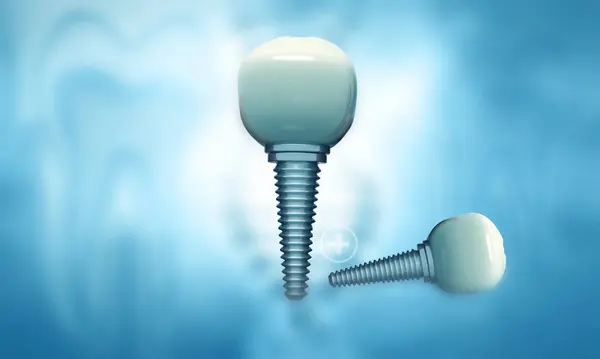 抽象的な医学的背景に関する歯科実装 3Dイラスト — ストック写真