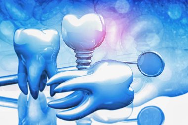 Diş implantı konsepti. 3d illüstrasyon
