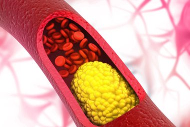 Tıkanmış Arterie. Tıbbi geçmişi var. 3d illüstrasyon