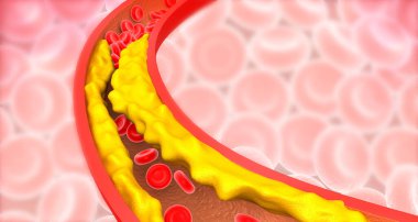 Artery blocked with bad cholesterol. clogged arteries, coronary artery plaque. 3d illustration	 clipart