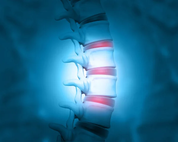 椎间盘问题人类脊椎 3D说明 — 图库照片