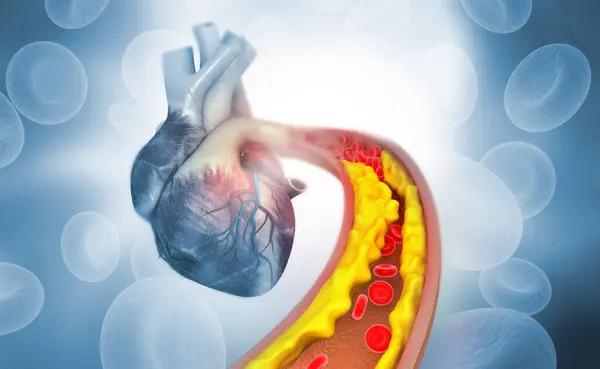 人的心脏解剖显示动脉内存在胆固醇斑块 3D说明 — 图库照片