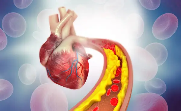 Cholesterol Plak Tepně Anatomií Lidského Srdce Ilustrace — Stock fotografie