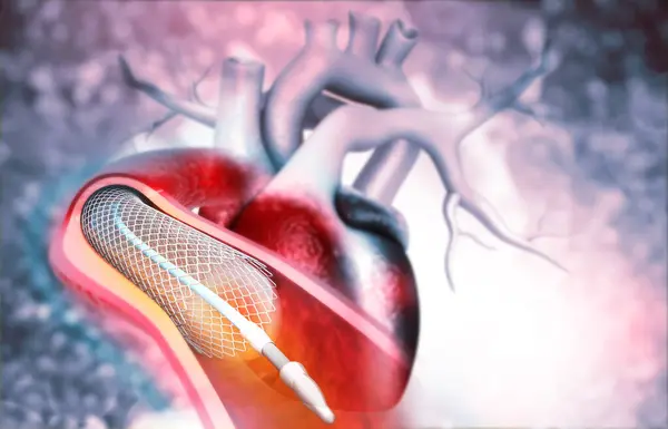 人类心脏血管成形术 3D说明 — 图库照片