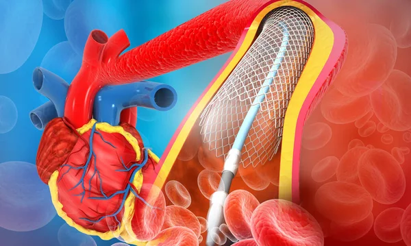 Angioplastia Cardíaca Humana Ilustração — Fotografia de Stock