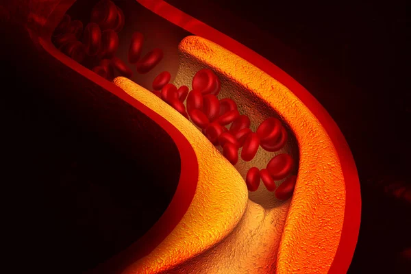 コレステロールは動脈をブロックします 3Dイラスト — ストック写真