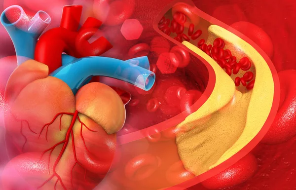 人的心脏动脉因胆固醇而堵塞 3D说明 — 图库照片
