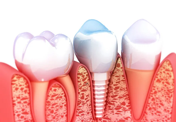 Implant Zębowy Ilustracja — Zdjęcie stockowe