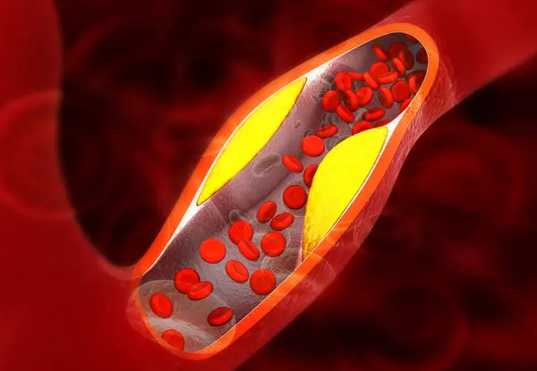 Cholesterol blocking artery. 3d illustration