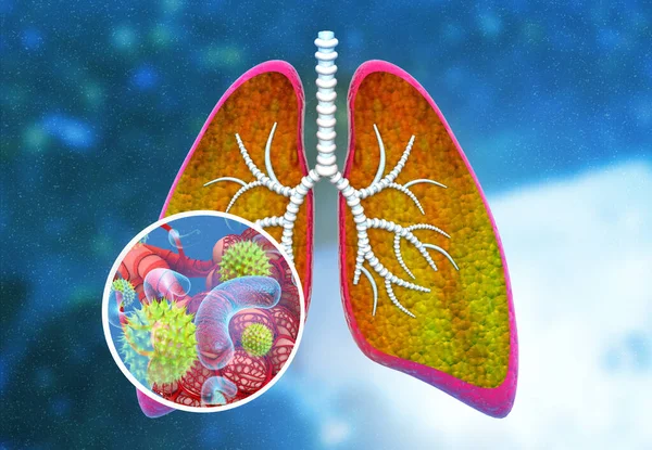 Virus Bacteria Human Lungs Illustration — Stock Photo, Image