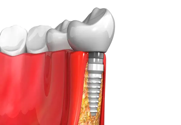 Зубні Імплантати Замість Пошкоджених Зубів Візуалізація — стокове фото