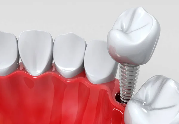 Dental Implants Instead Damaged Teeth Render — Stock Photo, Image