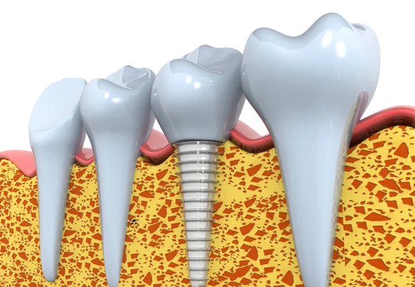 Dental Implants Instead Damaged Teeth Render — Stock Photo, Image