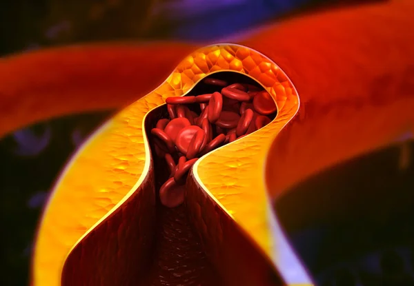 动脉被胆固醇阻断了堵塞的冠状动脉斑块 3D渲染 — 图库照片