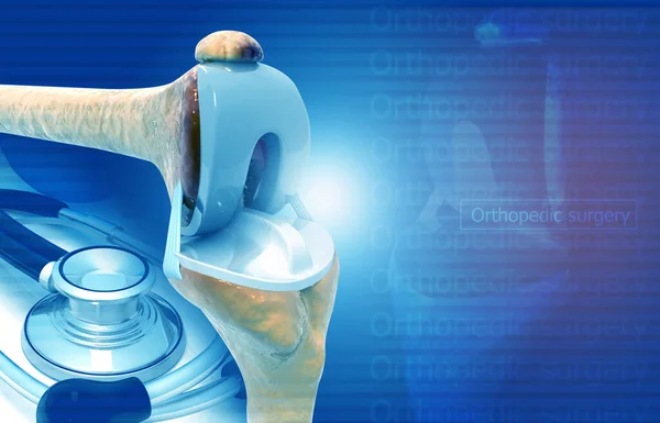 Kniegelenkersatz Medizinisches Hintergrundkonzept Illustration — Stockfoto