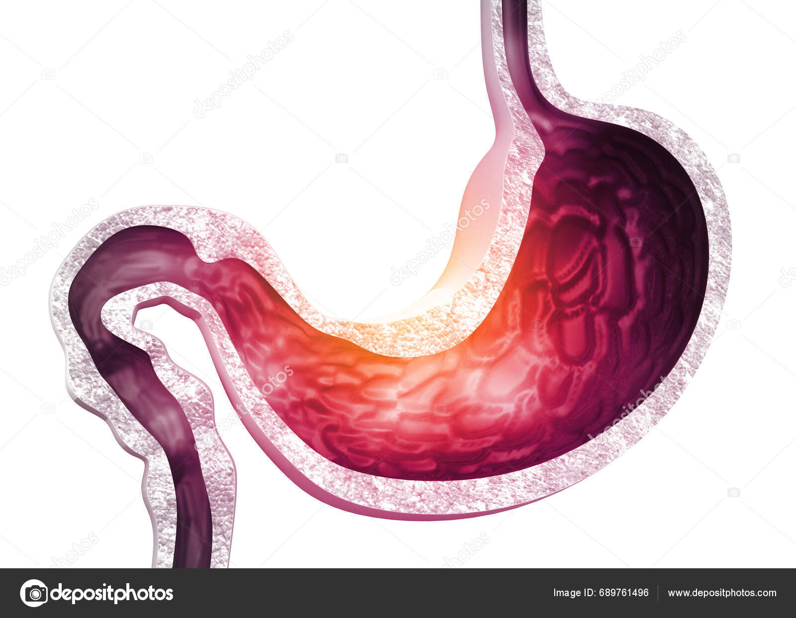 Imágenes de Apéndice inflamado libres de derechos | DepositPhotos, image size:1600x1243