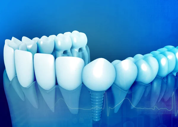 Anatomia Zębów Implantem Dentystycznym Renderowanie — Zdjęcie stockowe