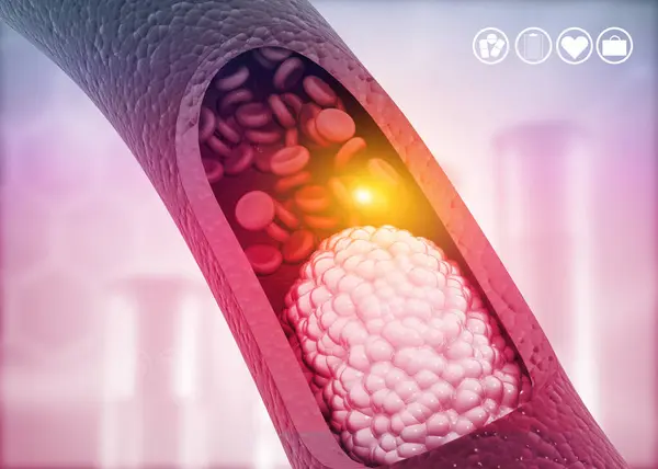 Ateroskleróza Cholesterol Plak Tepně Ilustrace — Stock fotografie