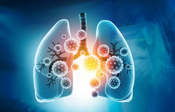 Infecciones Pulmonares Virales Infección Pulmonar Conservada Ilustración —  Fotos de Stock