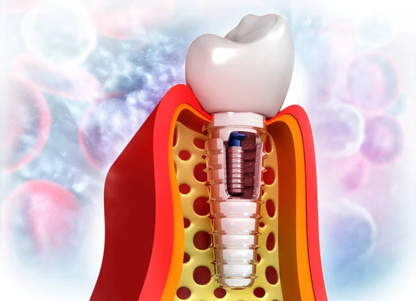 Nsan Diş Implantı Illüstrasyon — Stok fotoğraf