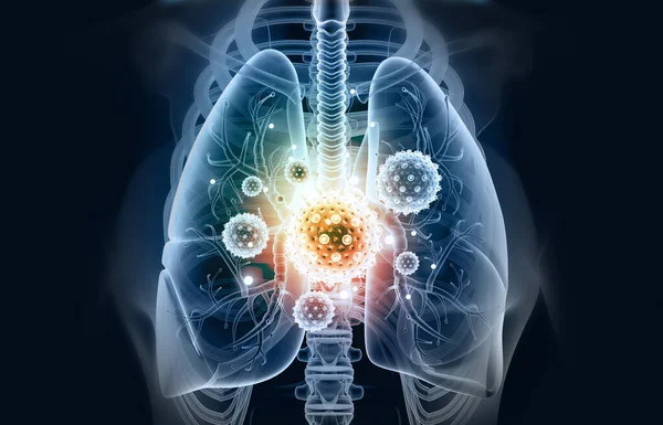 Pulmones Humanos Infectados Por Virus Bacterias Lungs Anatomy Ilustración —  Fotos de Stock