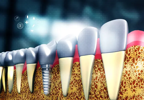 Diş Implantı Tıbbi Geçmiş Illüstrasyon — Stok fotoğraf