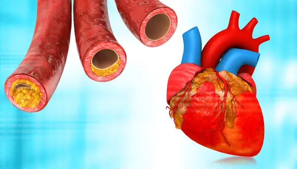 Human Heart Clogged Arteries Illustration — Stock Photo, Image