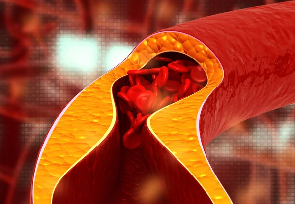 アテローム性動脈硬化症 コレステロールプラーク 3Dイラスト — ストック写真