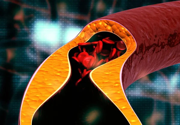 动脉粥样硬化 动脉内胆固醇斑块 3D说明 — 图库照片