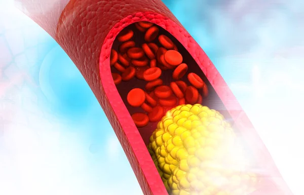 Clogged Arteries Cholesterol Plaque Artery Illustration — Stock Photo, Image