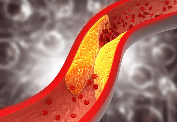 Засоренные артерии, мемориальная доска холестерина в артерии. 3d иллюстрация
