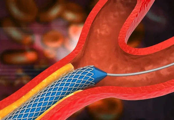 冠動脈ステント 詰まった動脈 3Dイラスト — ストック写真