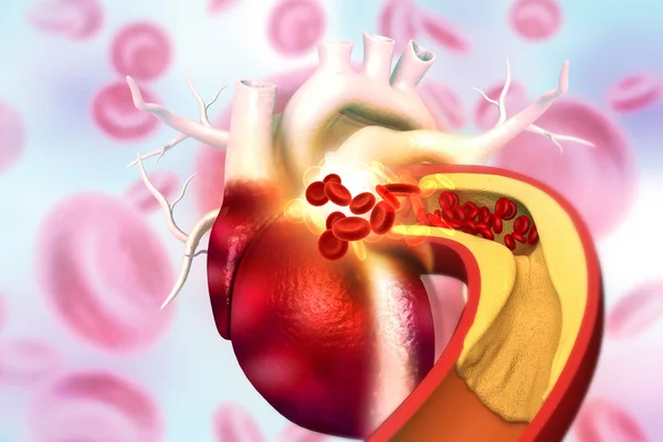 Cholesterol Plaque Artery Human Heart Anatomy Illustration — Stock Photo, Image