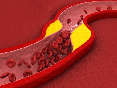 Tıkanmış arterler, arterde kolesterol plağı. 3d illüstrasyon