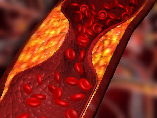 Clogged arteries, Cholesterol plaque in artery. 3d illustration	