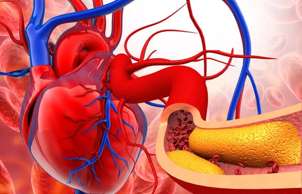 Kolesterol Plack Artär Med Mänskligt Hjärta Anatomi Illustration — Stockfoto