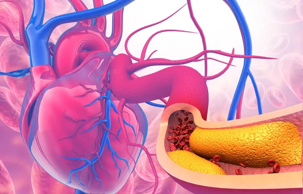 Kolesterol Plack Artär Med Mänskligt Hjärta Anatomi Illustration — Stockfoto