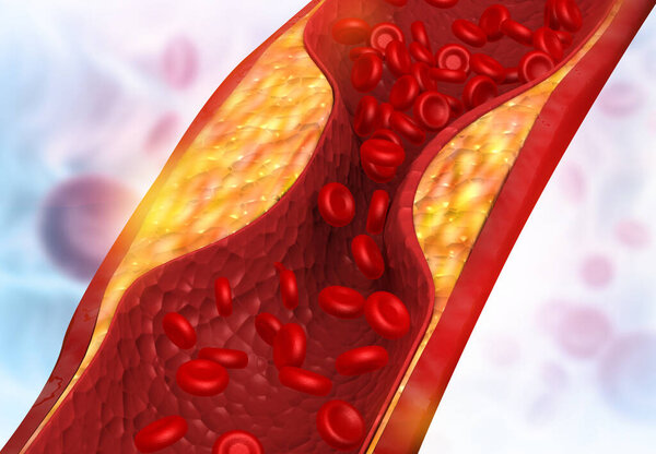 Clogged arteries. arterial plaque. Medical background. 3d illustration	