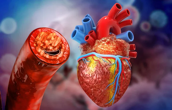 Human heart anatomy and clogged arteries. 3d illustration
