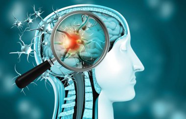 Beyinde virüs enfeksiyonu.