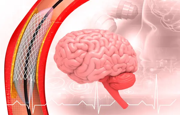 Stent Implant Human Brain Illustration — Stock Photo, Image