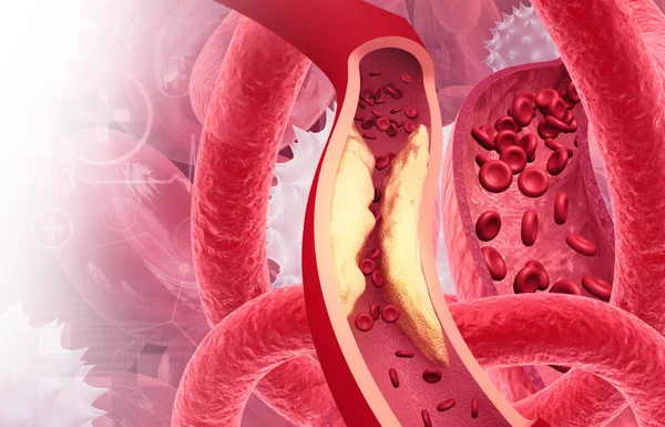 Placa Colesterol Artéria Artéria Bloqueada Ilustração — Fotografia de Stock